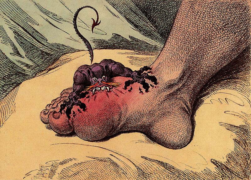 3. Bệnh Gout nguy hiểm gì? 1 3. Bệnh Gout nguy hiểm gì? 1