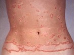 Kim Miễn Khang - Đem hy vọng cho bệnh Lupus ban đỏ hệ thống, bệnh vảy nến Kim Miễn Khang - Đem hy vọng cho bệnh Lupus ban đỏ hệ thống, bệnh vảy nếnKim Miễn Khang - Đem hy vọng cho bệnh Lupus ban đỏ hệ thống, bệnh vảy nến