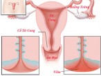 Những điều cần chú ý khi điều trị lộ tuyến cổ tử cung