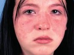 Bệnh Lupus ban đỏ hệ thống – Triệu chứng