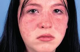 Bệnh Lupus ban đỏ hệ thống - Triệu chứng 1