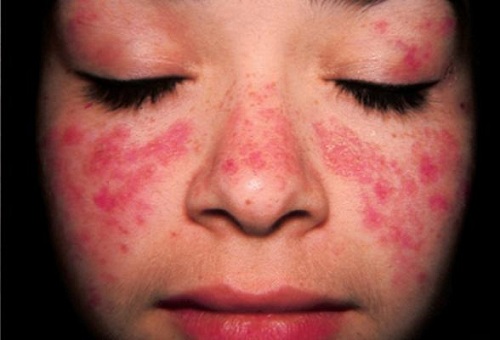 Những tổn thương gây ra do bệnh lupus ban đỏ
