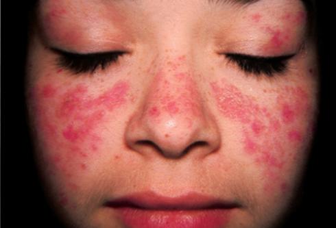 Nguyên nhân gây Lupus ban đỏ hệ thống 1