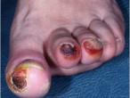 Loét bàn chân ở bệnh nhân tiểu đường: biến chứng không thể xem thường