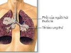 Ung thư phổi – Nguyên nhân và triệu chứng bạn nên biết!