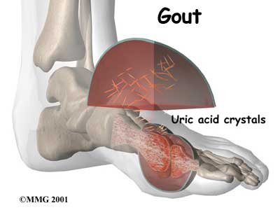 4. Gout 1