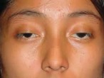 Sụp mí mắt có thể là biểu hiện của bệnh nhược cơ